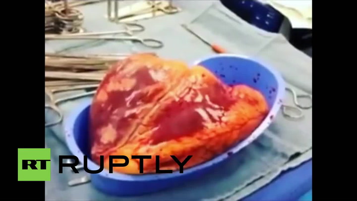Šokující video! Srdce člověka závislého na kokainu bije ještě 25 minut po smrti