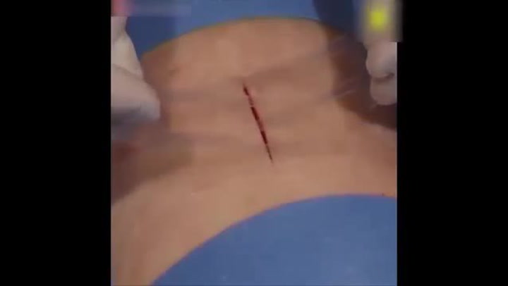 Revoluce ve zdravotnictví? I velké rány se dají vyřešit pomocí zázračné lepící pásky!