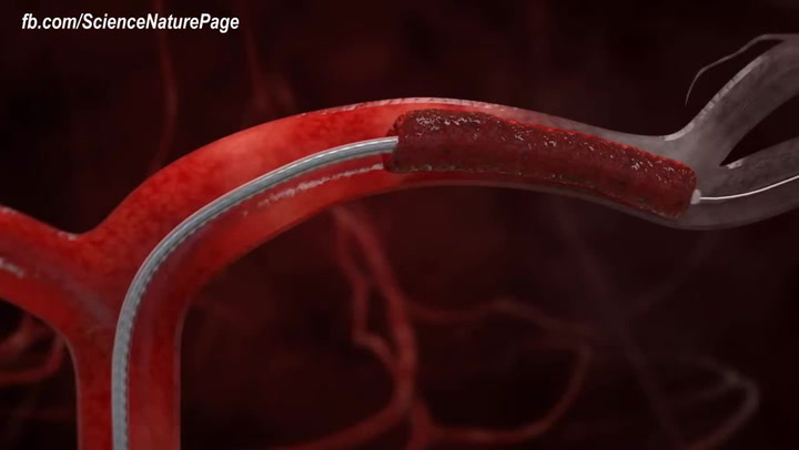 Revoluční technologie! Takhle chtějí lékaři bojovat s ucpanými tepnami